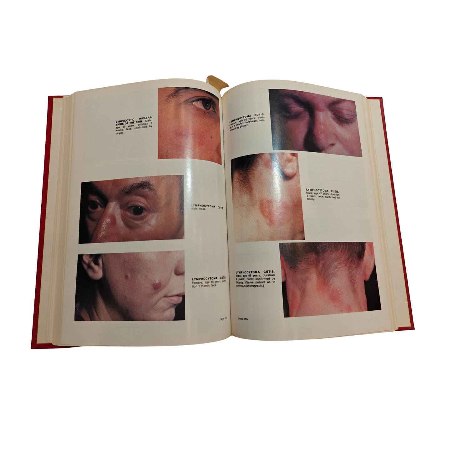 Atlas of Tumors of the Skin 1978 By Kopf, Bart, Andrade | Dermatology Hardcover