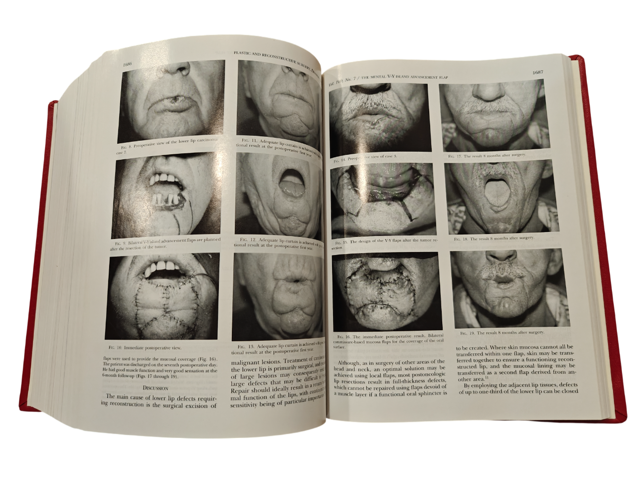 Plastic and Reconstructive Surgery Vol 100 No.1–7 1997 Hardcover Medical Journal