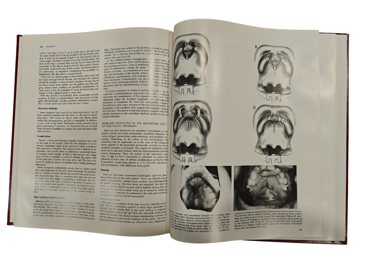 Surgical Techniques in Cleft Lip and Palate Medical Textbook by Bardach | Salyer